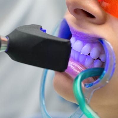 TEETH WHITENING